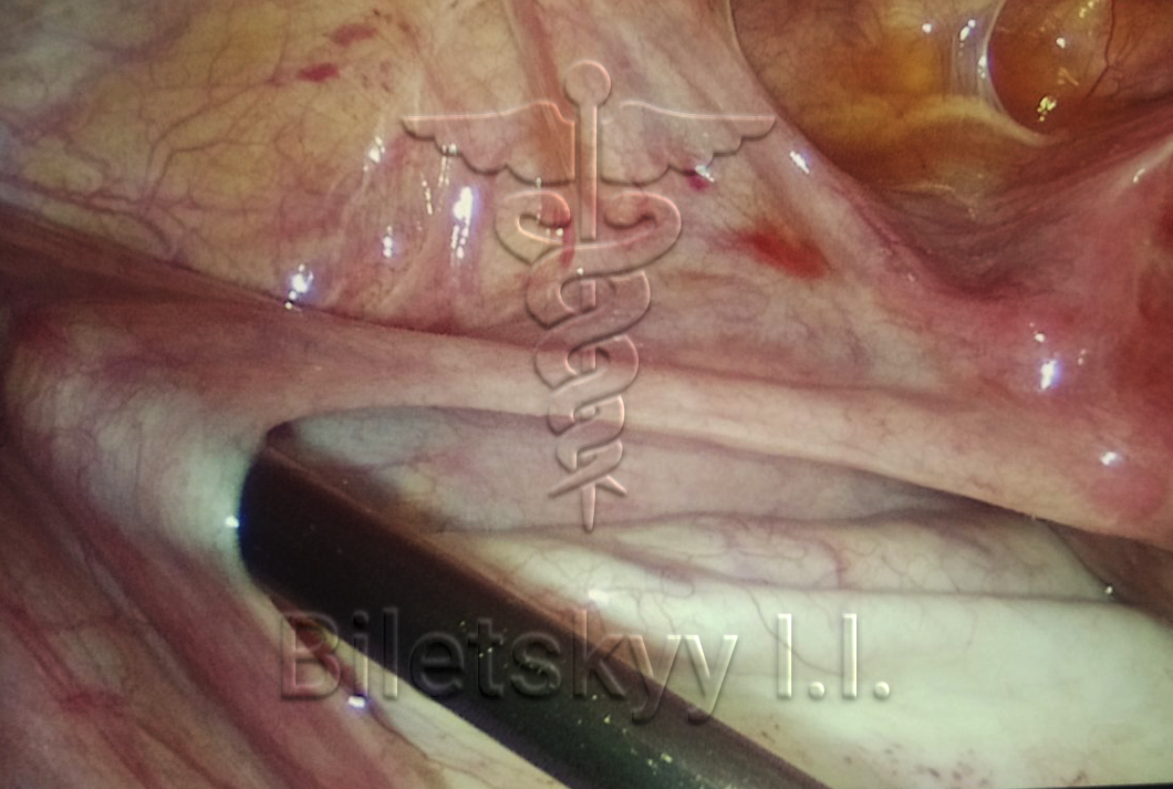 Multichamber ovarian cyst 5 liters