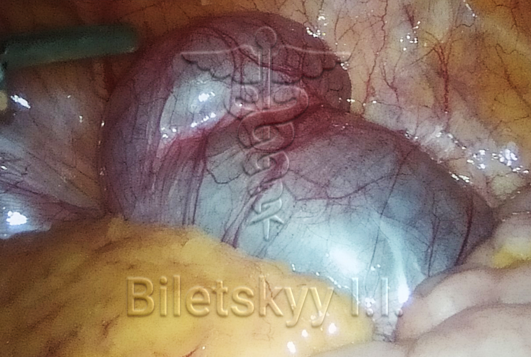 Hydrosalpinx of the fallopian tube