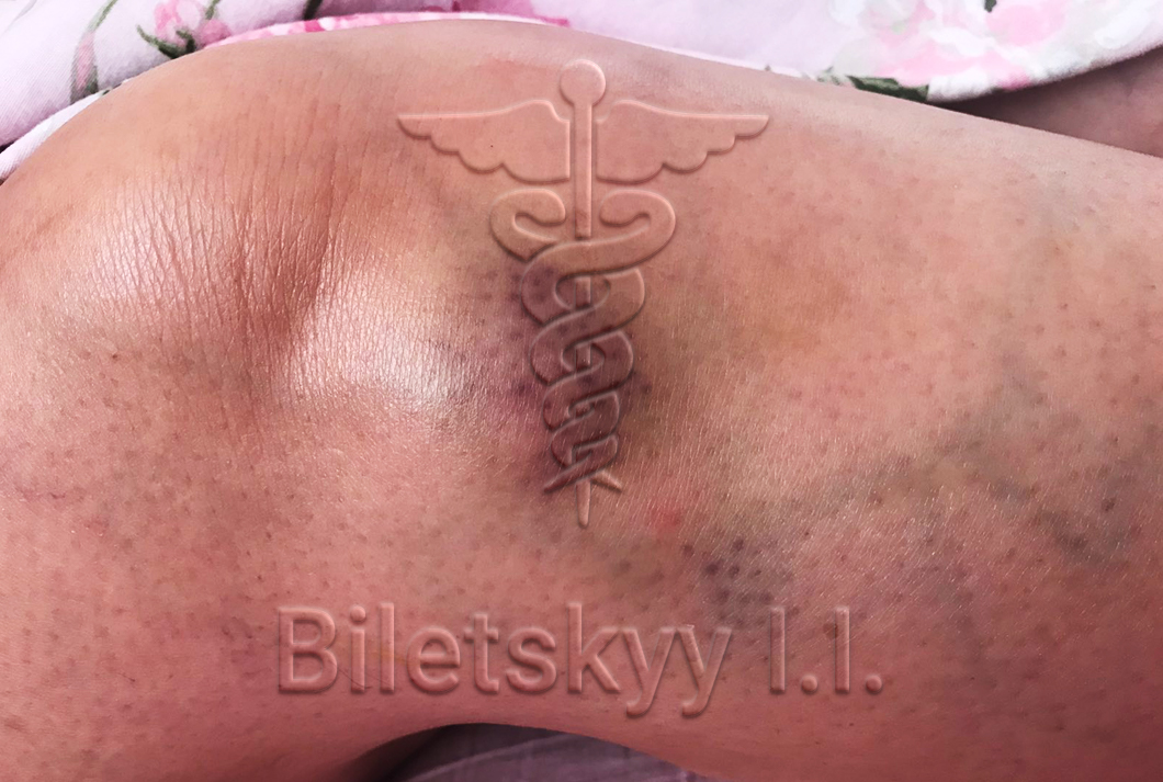 Lipoma<br><br>