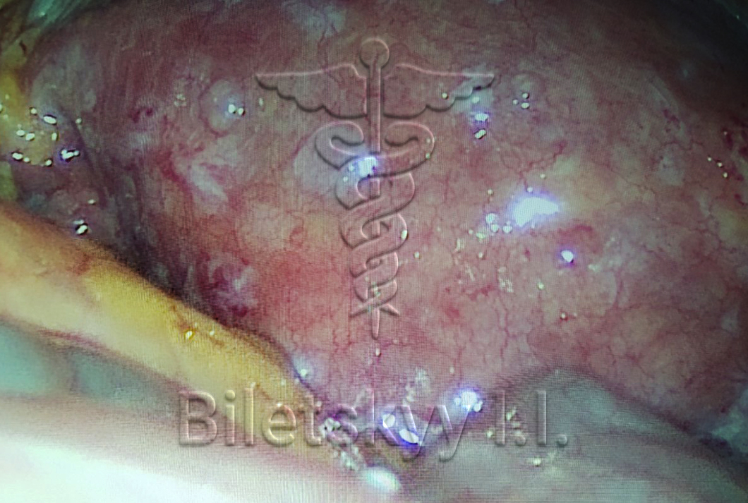 Пельвиоперитонит<br><br>