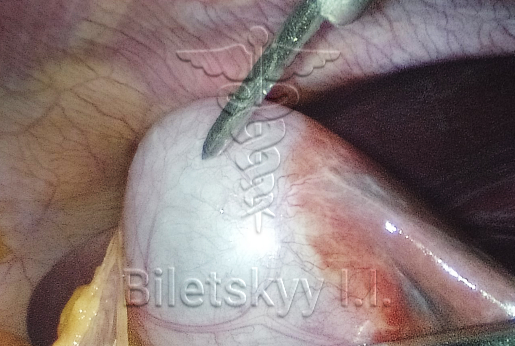 Емпієма жовчного міхура