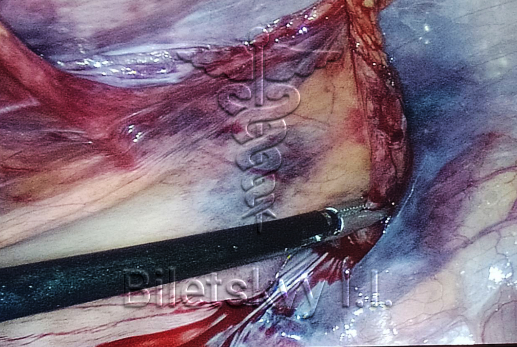 Килосічення<br><br>